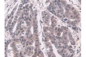 Detection of LMP7 in Human Liver cancer Tissue using Polyclonal Antibody to Large Multifunctional Peptidase 7 (LMP7) (PSMB8 antibody  (AA 75-261))