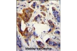 UBFD1 antibody (N-term) (ABIN655026 and ABIN2844657) immunohistochemistry analysis in formalin fixed and paraffin embedded human bladder carcinoma followed by peroxidase conjugation of the secondary antibody and DAB staining. (UBFD1 antibody  (N-Term))