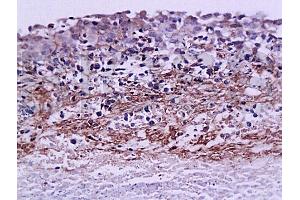 Formalin-fixed and paraffin embedded rat ovary carcinoma labeled with Anti-MMP-9 Polyclonal Antibody, Unconjugated (ABIN668095) at 1:200, followed by conjugation to the secondary antibody and DAB staining (MMP 9 antibody  (AA 611-707))
