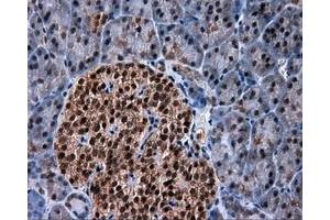 Immunohistochemical staining of paraffin-embedded Adenocarcinoma of colon tissue using anti-SRR mouse monoclonal antibody.
