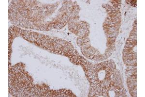IHC-P Image Immunohistochemical analysis of paraffin-embedded human colon carcinoma, using PNPase, antibody at 1:250 dilution. (PNPT1 antibody  (N-Term))