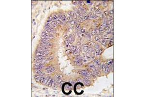 Formalin-fixed and paraffin-embedded human colon carcinoma tissue reacted with PDE8A antibody (L572), which was peroxidase-conjugated to the secondary antibody, followed by DAB staining. (PDE8A antibody  (AA 557-587))