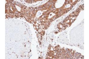 IHC-P Image Immunohistochemical analysis of paraffin-embedded human endo mitral ovarian cancer, using ERLIN2, antibody at 1:100 dilution.