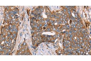 Immunohistochemistry of paraffin-embedded Human cervical cancer using FUCA1 Polyclonal Antibody at dilution of 1:30 (FUCA1 antibody)