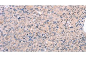 Immunohistochemistry of paraffin-embedded Human cervical cancer using EDG3 Polyclonal Antibody at dilution of 1:30 (S1PR3 antibody)