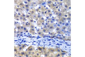 Immunohistochemistry of paraffin-embedded human liver injury using PSMD8 antibody at dilution of 1:100 (x40 lens).