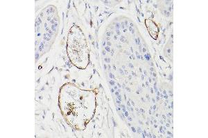 Immunohistochemistry of paraffin-embedded human esophageal cancer using CD34 Rabbit pAb (ABIN6134661, ABIN6138169, ABIN6138171 and ABIN6218103) at dilution of 1:100 (40x lens). (CD34 antibody  (C-Term))
