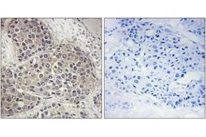 Immunohistochemistry analysis of paraffin-embedded human breast carcinoma, using p70 S6 Kinase (Phospho-Ser424) Antibody. (RPS6KB1 antibody  (pSer447))