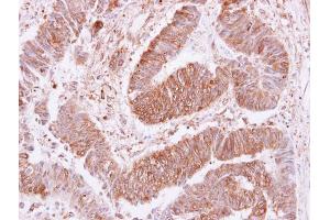 IHC-P Image VPS35 antibody [C3], C-term detects VPS35 protein at cytoplasm and membrane on human colon carcinoma by immunohistochemical analysis. (VPS35 antibody  (C-Term))