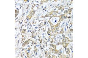 Immunohistochemistry of paraffin-embedded human gastric cancer using TICAM1 antibody. (TICAM1 antibody  (AA 20-200))