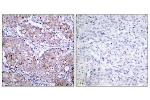 Immunohistochemical analysis of paraffin-embedded human breast carcinoma tissue using EGFR(Phospho-Ser1070) Antibody(left) or the same antibody preincubated with blocking peptide(right).