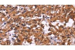 Immunohistochemistry of paraffin-embedded Human thyroid cancer tissue using MSH4 Polyclonal Antibody at dilution 1:30 (MSH4 antibody)