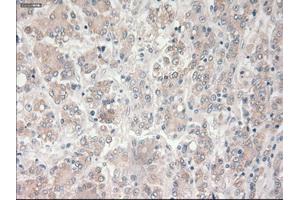 Immunohistochemical staining of paraffin-embedded Carcinoma of liver tissue using anti-PROM2mouse monoclonal antibody. (Prominin 2 antibody)