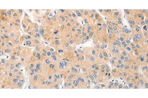 Immunohistochemistry of paraffin-embedded Human liver cancer using RPN1 Polyclonal Antibody at dilution of 1:30 (RPN1 antibody)