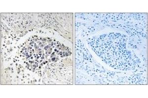 Immunohistochemistry analysis of paraffin-embedded human lung carcinoma tissue, using CPNE8 Antibody. (CPNE8 antibody  (AA 11-60))