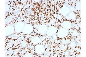 FFPE human angiosarcoma tested with Histone antibody (AE-4) (Histone antibody)