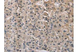 The image on the left is immunohistochemistry of paraffin-embedded Human liver cancer tissue using ABIN7129403(ESRRG Antibody) at dilution 1/30, on the right is treated with fusion protein. (ESRRG antibody)