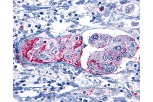 Anti-GRM8 / MGLUR8 antibody IHC of human Pancreas, Carcinoma. (GRM8 antibody  (C-Term))