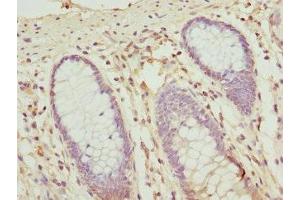 Immunohistochemistry of paraffin-embedded human colon cancer using ABIN7162209 at dilution of 1:100
