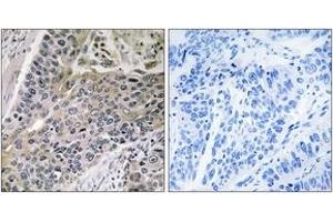 Immunohistochemistry analysis of paraffin-embedded human lung carcinoma tissue, using MRPS7 Antibody.