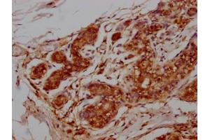 IHC image of MA004969A0m diluted at 1:100 and staining in paraffin-embedded human breast cancer tissue performed on a Leica BondTM system.