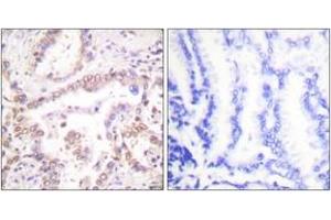 Immunohistochemistry analysis of paraffin-embedded human lung carcinoma tissue, using SKP2/p45 Antibody. (SKP2 antibody  (AA 366-415))