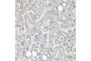 Immunohistochemistry of paraffin-embedded human liver injury using MUC16 antibody at dilution of 1:100 (x40 lens).