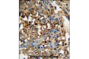 DMP4 antibody immunohistochemistry analysis in formalin fixed and paraffin embedded human breast carcinoma followed by peroxidase conjugation of the secondary antibody and DAB staining.