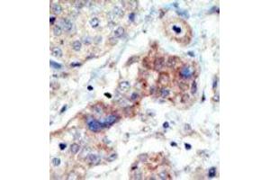 Formalin-fixed and paraffin-embedded human cancer tissue reacted with the primary antibody, which was peroxidase-conjugated to the secondary antibody, followed by DAB staining. (EPH Receptor B3 antibody  (N-Term))