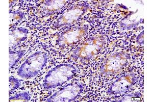 Formalin-fixed and paraffin embedded human colon carcinoma labeled with Anti-phospho-PRKCZ(Thr500) Polyclonal Antibody, Unconjugated (ABIN741240) at 1:200 followed by conjugation to the secondary antibody and DAB staining (PKC beta antibody  (pThr500))