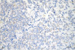 Immunohistochemistry was performed on paraffin-embedded human breast carcinoma using HDHD5 antibody (ABIN7798836), 1:200).