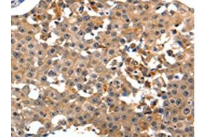 The image on the left is immunohistochemistry of paraffin-embedded Human breast cancer tissue using ABIN7190883(GRM1 Antibody) at dilution 1/15, on the right is treated with synthetic peptide. (Metabotropic Glutamate Receptor 1 antibody)