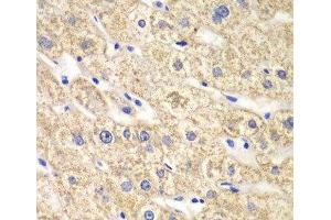 Immunohistochemistry of paraffin-embedded Human liver damage using ACADS Polyclonal Antibody at dilution of 1:100 (40x lens). (ACADS antibody)