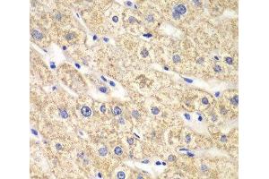 Immunohistochemistry of paraffin-embedded Human liver damage using ACADS Polyclonal Antibody at dilution of 1:100 (40x lens).
