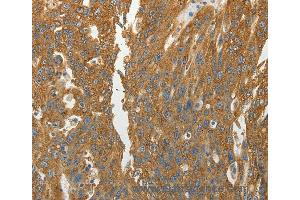 Immunohistochemistry of Human ovarian cancer using RPLP0 Polyclonal Antibody at dilution of 1:40 (RPLP0 antibody)