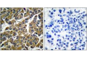 Immunohistochemistry analysis of paraffin-embedded human breast carcinoma tissue, using MMP-3 Antibody. (MMP3 antibody  (AA 421-470))