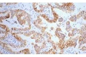 Immunohistochemistry of paraffin-embedded Human lung cancer tissue using CK-7 Monoclonal Antibody at dilution of 1:200. (Cytokeratin 7 antibody)