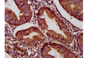 IHC image of ABIN7160839 diluted at 1:500 and staining in paraffin-embedded human endometrial cancer performed on a Leica BondTM system. (NADK2 antibody  (AA 16-156))