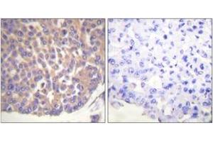 Immunohistochemistry analysis of paraffin-embedded human breast carcinoma tissue, using Filamin A (Ab-2152) Antibody. (Filamin A antibody  (AA 2121-2170))