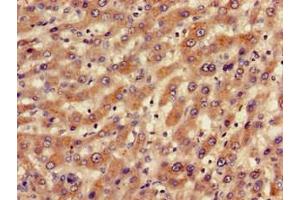 Immunohistochemistry of paraffin-embedded human liver cancer using ABIN7145235 at dilution of 1:100 (BBS1 antibody  (AA 435-552))