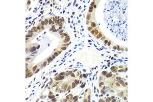 Immunohistochemistry of paraffin-embedded human gastric cancer using RNF2 antibody. (RNF2 antibody)