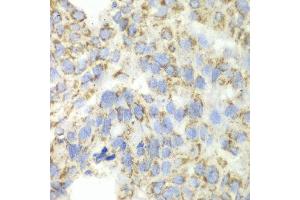 Immunohistochemistry of paraffin-embedded human esophageal cancer using ALDH4A1 antibody at dilution of 1:100 (x40 lens). (ALDH4A1 antibody)