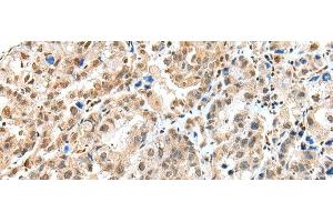 Immunohistochemistry of paraffin-embedded Human ovarian cancer tissue using S100A16 Polyclonal Antibody at dilution of 1:25(x200)