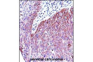 KRT6B Antibody (Center) (ABIN657654 and ABIN2846649) immunohistochemistry analysis in formalin fixed and paraffin embedded human cervical carcinoma followed by peroxidase conjugation of the secondary antibody and DAB staining. (Keratin 6B antibody  (AA 207-236))