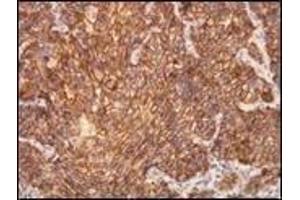 Immunohistochemistry (IHC) image for anti-Receptor tyrosine-protein kinase erbB-2 (ErbB2/Her2) (C-Term) antibody (ABIN870541) (ErbB2/Her2 antibody  (C-Term))