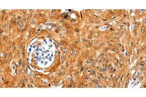 Immunohistochemistry of paraffin-embedded Human cervical cancer tissue using NCOR1 Polyclonal Antibody at dilution 1:100 (NCOR1 antibody)
