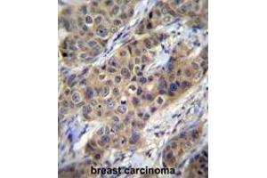 TGFB1 Antibody (N-term) immunohistochemistry analysis in formalin fixed and paraffin embedded human breast carcinoma followed by peroxidase conjugation of the secondary antibody and DAB staining. (TGFB1 antibody  (N-Term))