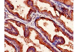 Immunohistochemistry of paraffin-embedded human prostate cancer using ABIN7161940 at dilution of 1:100 (NXF5 antibody  (AA 1-200))