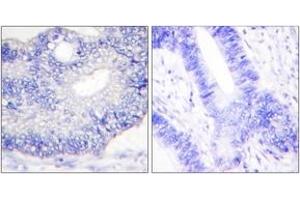 Immunohistochemistry analysis of paraffin-embedded human colon carcinoma tissue, using TGF alpha Antibody.