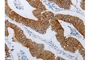 The image on the left is immunohistochemistry of paraffin-embedded Human colon cancer tissue using ABIN7192809(TMEM8B Antibody) at dilution 1/15, on the right is treated with synthetic peptide. (TMEM8B antibody)